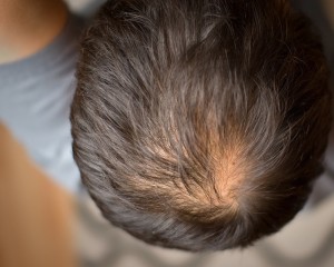 ereditarietà caduta dei capelli