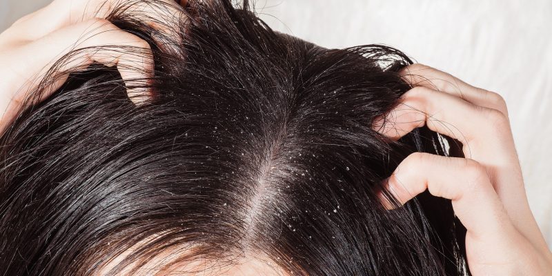 Capelli con forfora | Prontocapelli