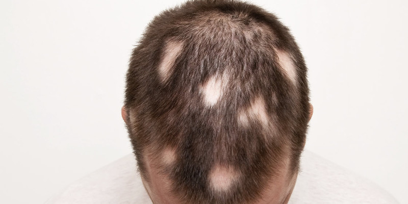 alopecia areata