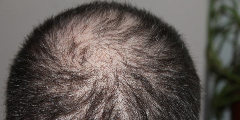 perdita di capelli_diabete